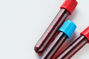 Platelet-rich Plasma