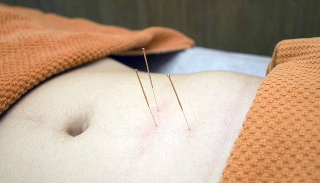 การฝังเข็ม, acupuncture